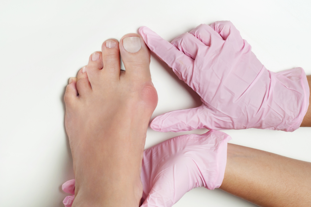 Guide on Bunions