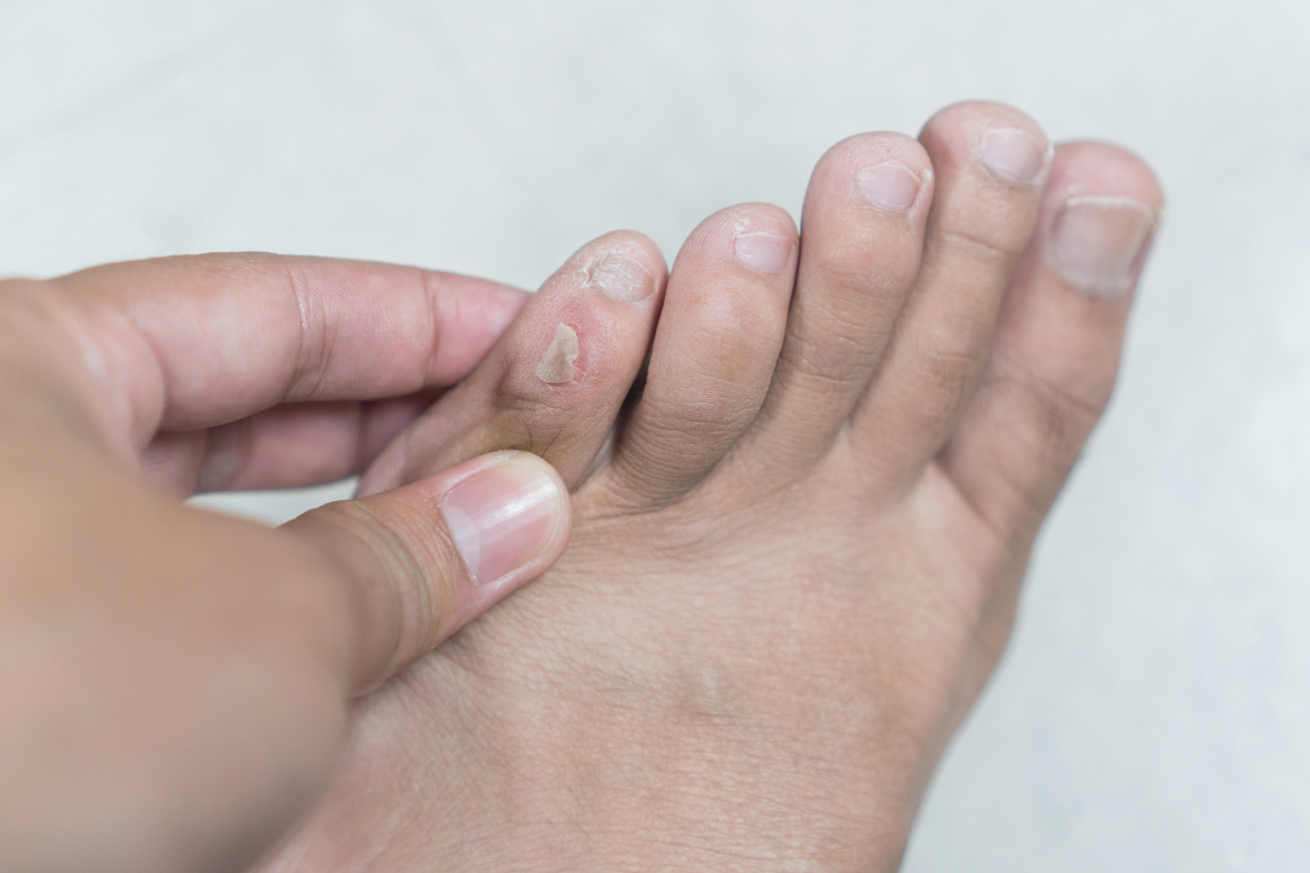 Common Foot Skin Problems And Their Treatments