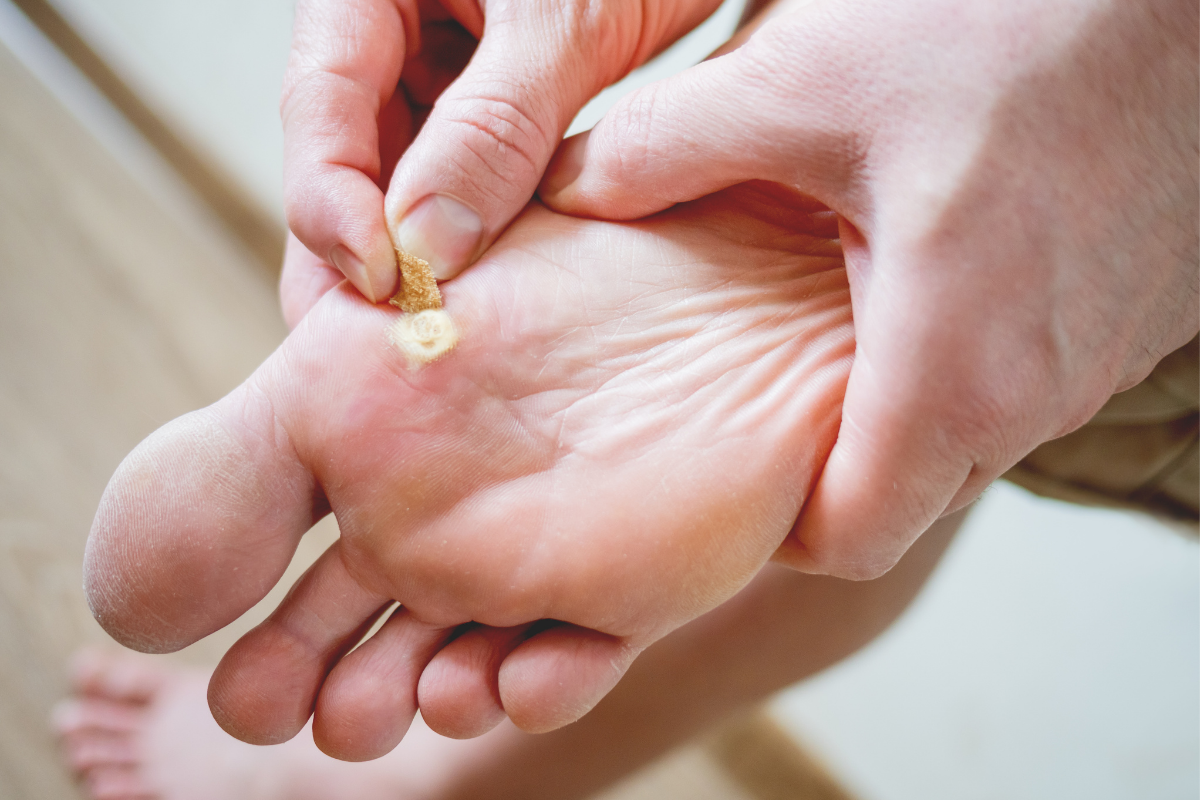 Plantar Warts Cause