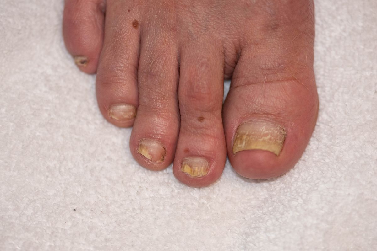 toenail fungus