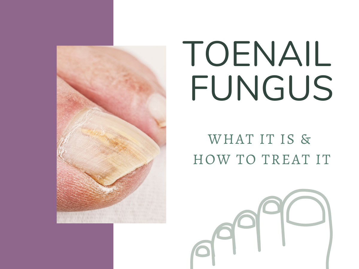 Natural Remedies for Fungal Nail Infections