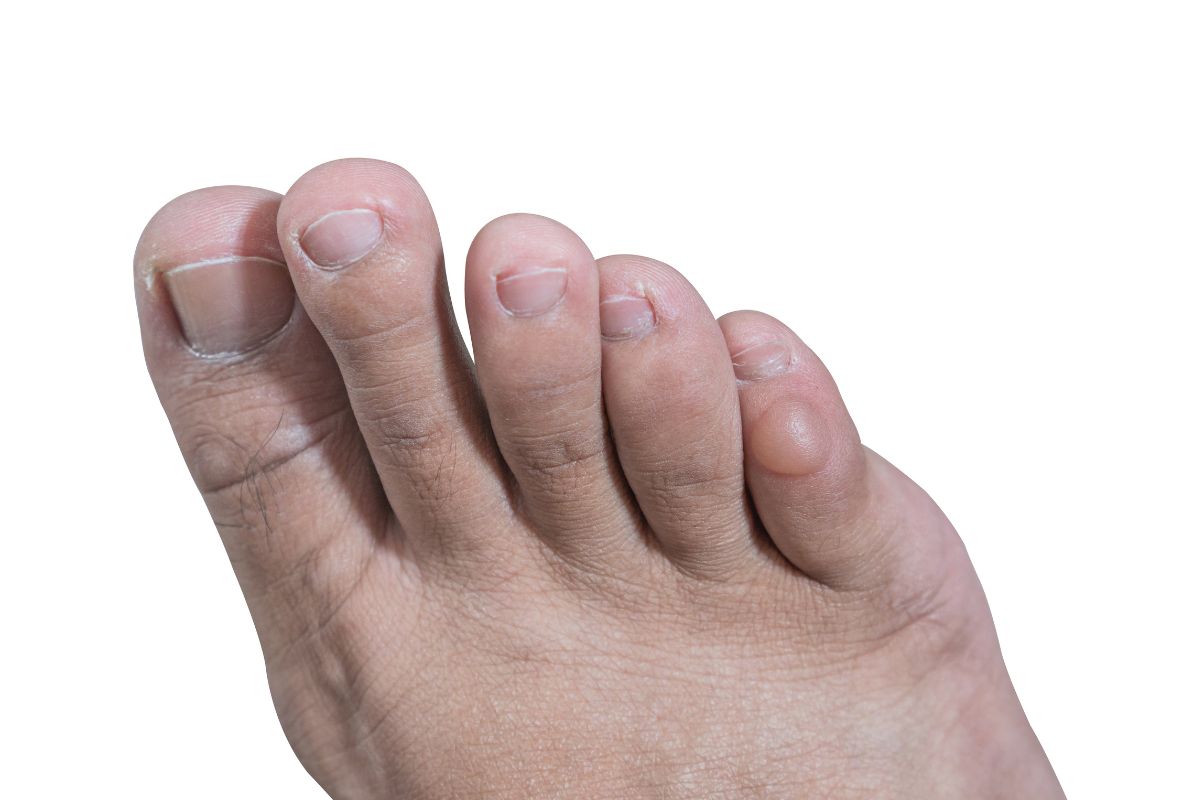 Toenail Blisters: 7 Causes, 7 Fixes - Blister Prevention - Rebecca