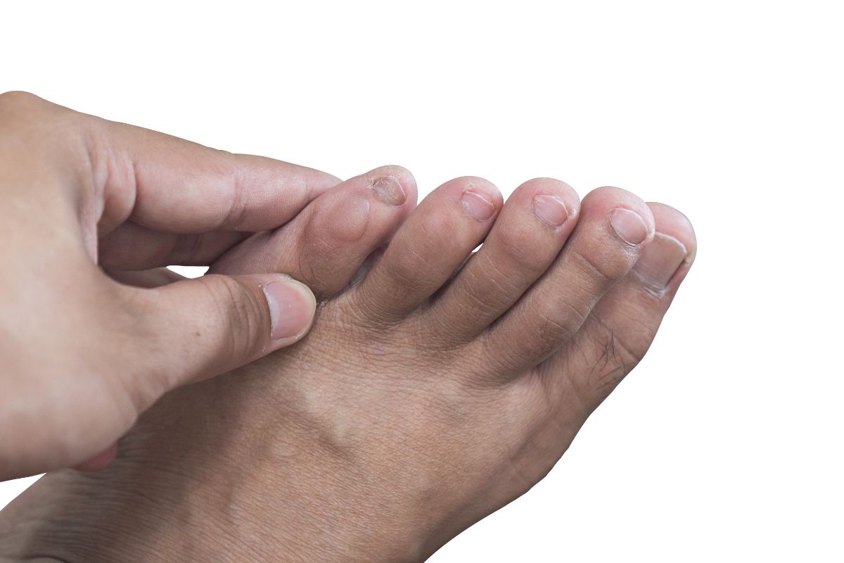How to Prevent Foot Blisters