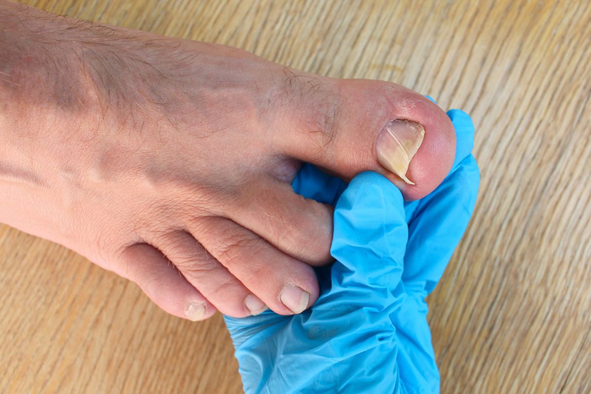 What Should You Do If You Have A Damaged Toenail Howard County Foot 