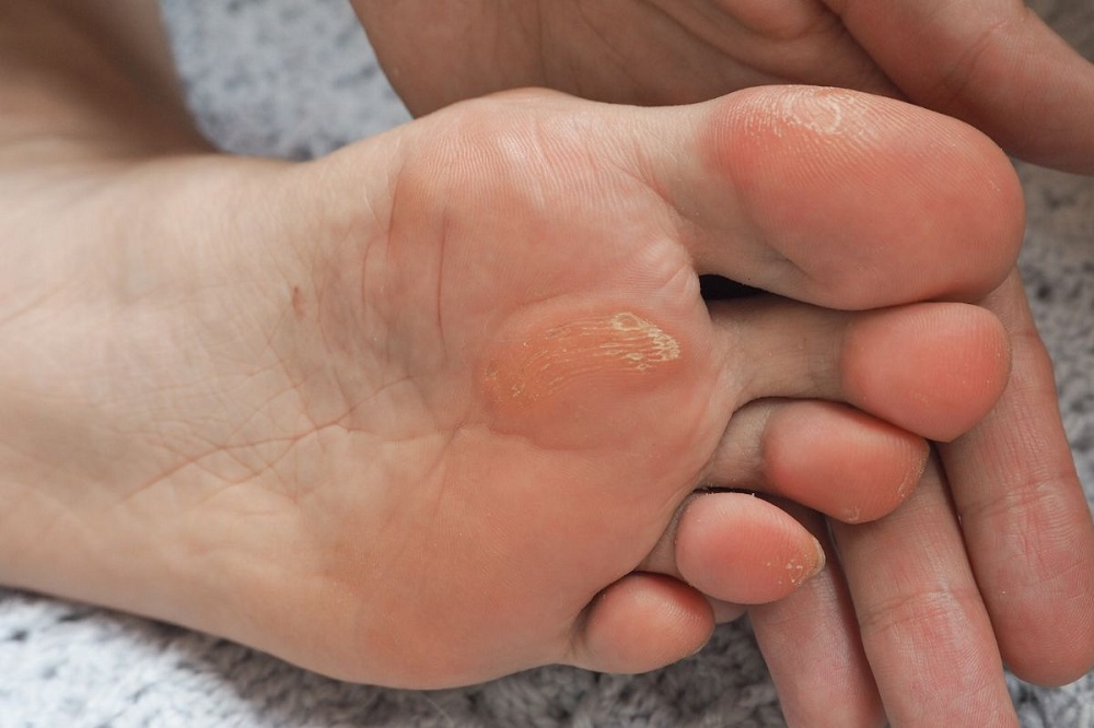 Causes of Peeling Foot