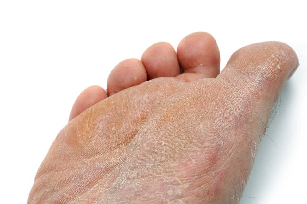 Foot Skin Peeling