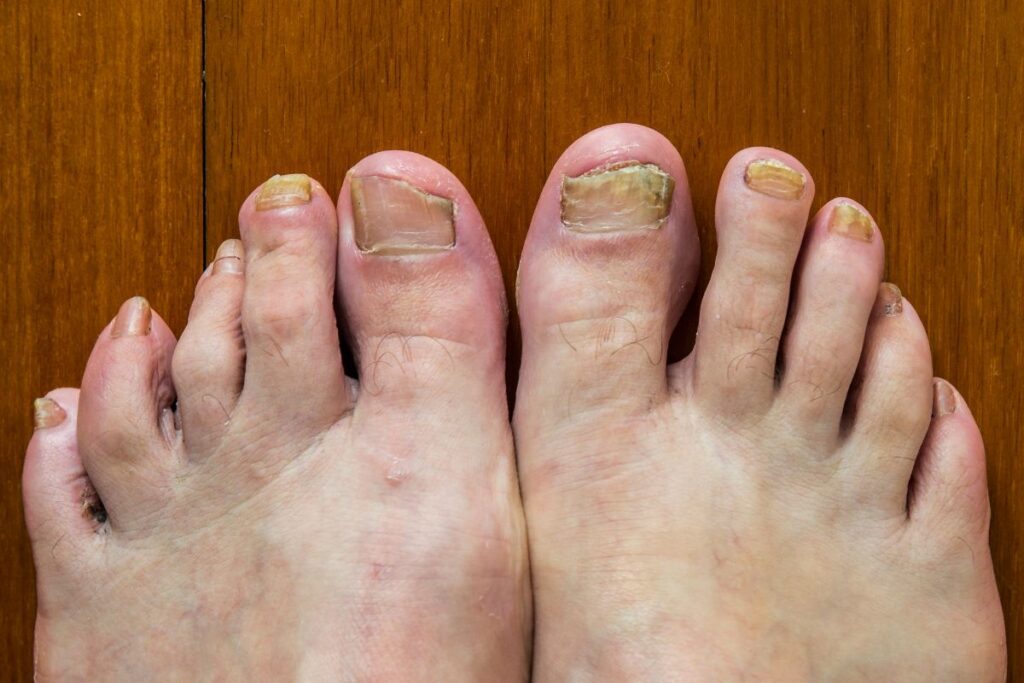 Get To Know The Common Foot Problems During The Colder Season - Howard ...