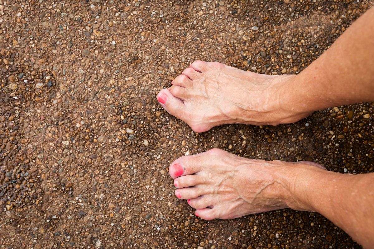 Hammertoe Causes